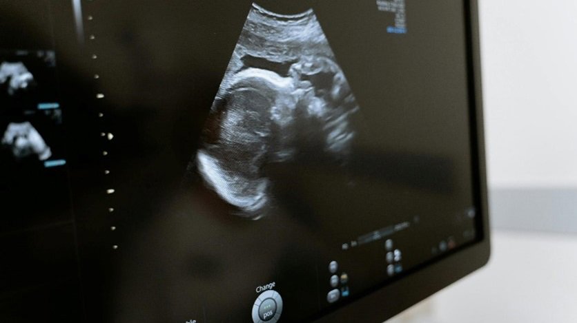 an ultrasound scan of a baby