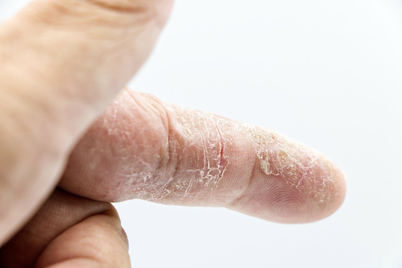 A close up of a finger with dry and cracked skin
